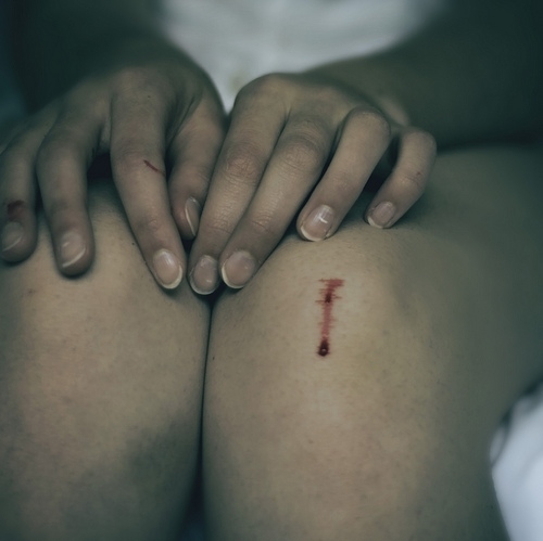 blood,  bruise and  girl