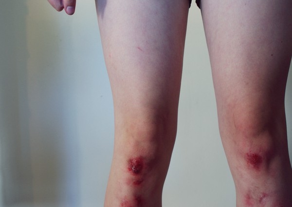 blood,  bruise and  legs