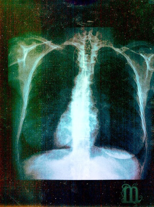 bone, human and lungs