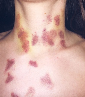 bites, boyfriend and bruises